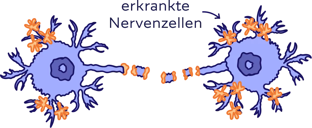 Zwei erkrankte Nervenzellen und deren gestörte Verbindung. 